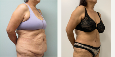 Tummy Tuck before and after photo
