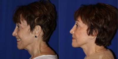 Facelift before and after photo