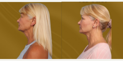 Facelift before and after photo