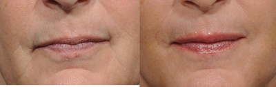 Facial Fat Transfer before and after photo
