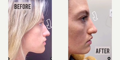 Nonsurgical Nose Job before and after photo
