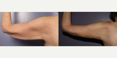 Arm Lift before and after photo