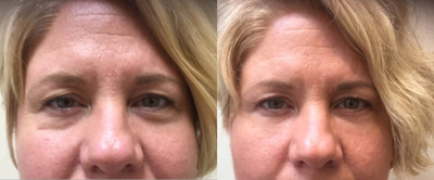 Belotero before and after photo