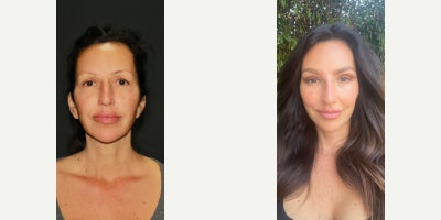Brow Lift before and after photo