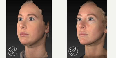 Buccal Fat Removal before and after photo