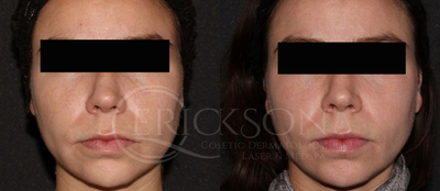 Laser Resurfacing before and after photo