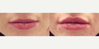 Lip Fillers before and after photo