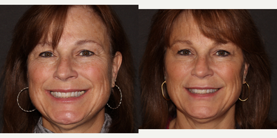 Liquid Facelift before and after photo