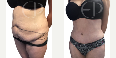 Tummy Tuck before and after photo