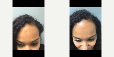 Bellafill before and after photo
