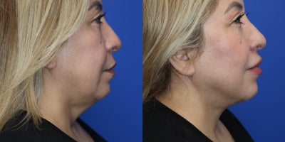 Chin Liposuction before and after photo