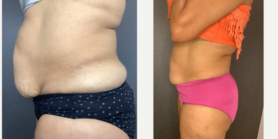 Emsculpt before and after photo
