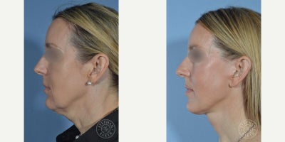 Facelift before and after photo