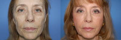 Facial Fat Transfer before and after photo