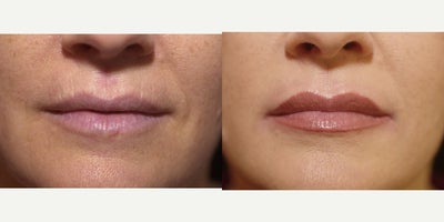 Lip Fillers before and after photo