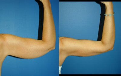 Liposuction before and after photo