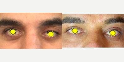 Ptosis Surgery before and after photo