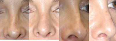 Revision Rhinoplasty before and after photo