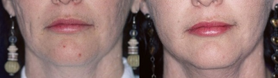 Subcision before and after photo