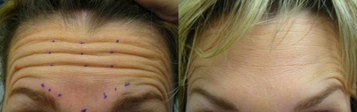 Botox before and after photo
