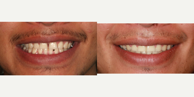Braces before and after photo