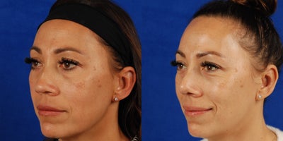 Revision Rhinoplasty before and after photo