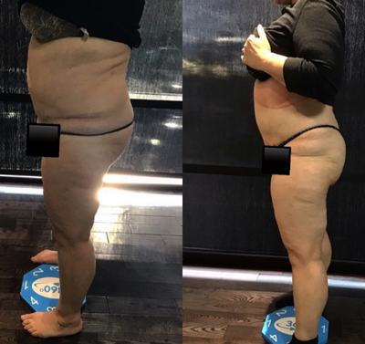 Cryolipolysis before and after photo