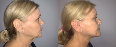 Facelift before and after photo