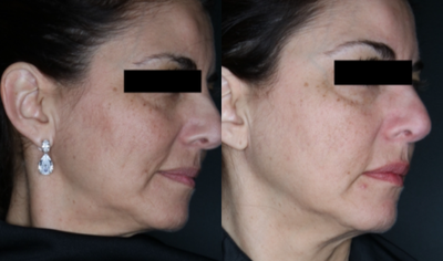 Halo Laser before and after photo