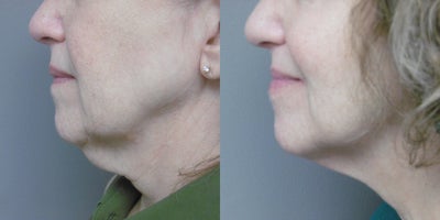 Kybella before and after photo