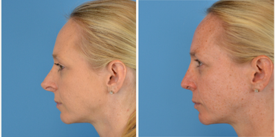 Revision Rhinoplasty before and after photo