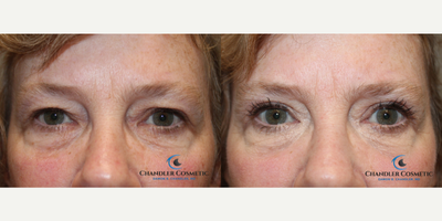 Eyelid Surgery before and after photo