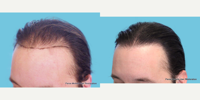 Hair Transplant before and after photo