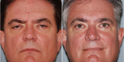 Brow Lift before and after photo