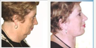 Facelift before and after photo