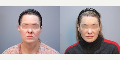 Forehead Reduction before and after photo