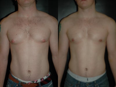 Gynecomastia Surgery before and after photo