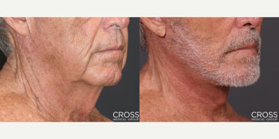 Facelift before and after photo