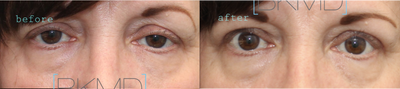 Ptosis Surgery before and after photo