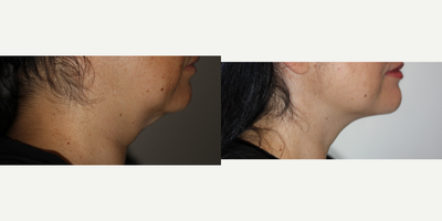 SculpSure before and after photo