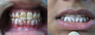 Teeth Whitening before and after photo