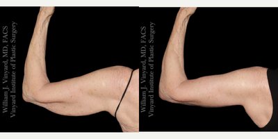 Arm Lift before and after photo