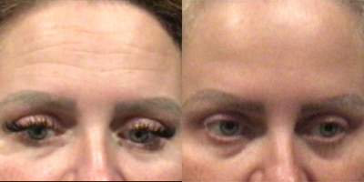 Botox before and after photo