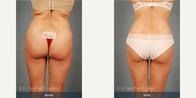Mommy Makeover before and after photo