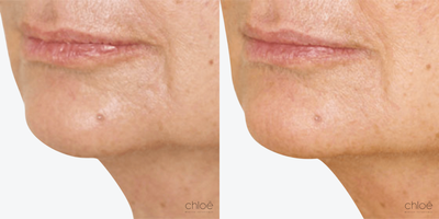 Radiesse before and after photo