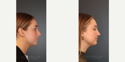 Rhinoplasty before and after photo