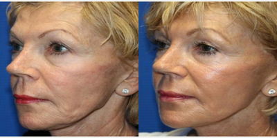 Skin Tightening before and after photo