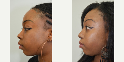African American Rhinoplasty before and after photo