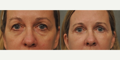 Eyelid Surgery before and after photo