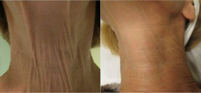 Fractora RF before and after photo